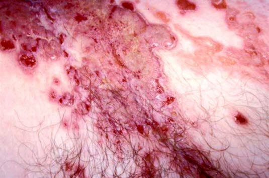 Pemphigus vulgaris: Schlaffe Blasen in verschiedenen Größen auf normaler Haut, diese platzen leicht und gehen zu erythematöser, erodierter Haut über.