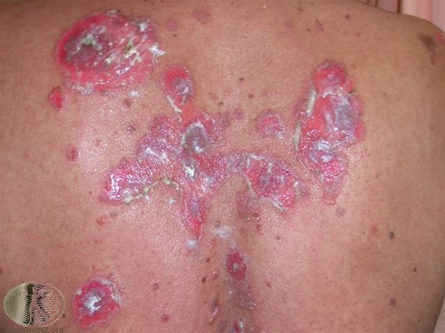 Pemphigus