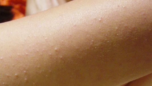 Keratosis Pilaris Reibeisenhaut Deximed