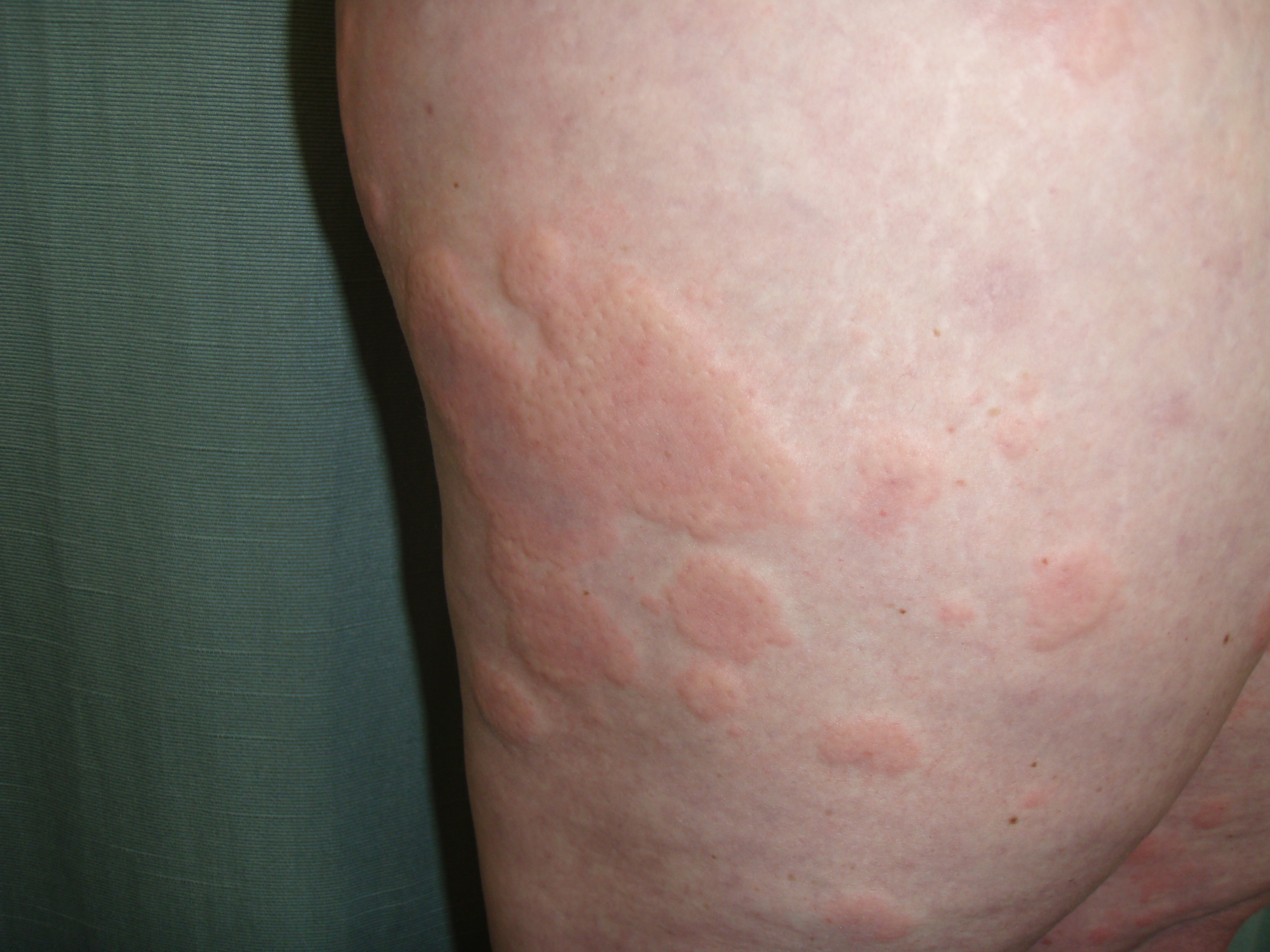 ausschlag körper juckreiz