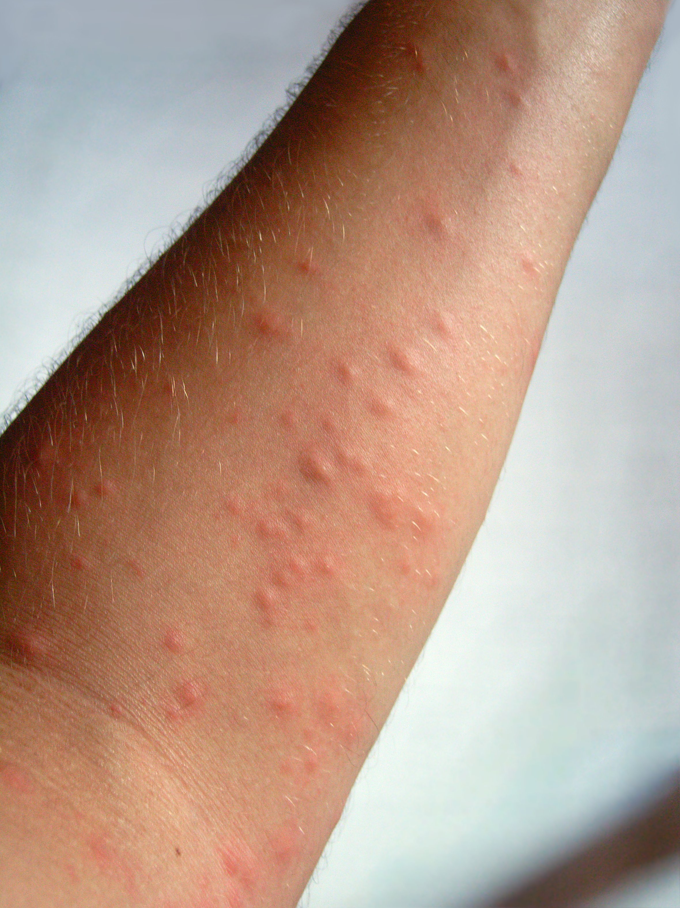 Eichenprozessionsspinner-Dermatitis (Raupendermatitis) - DEXIMED  Deutsche  Experteninformation Medizin