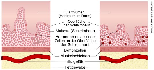 Zöliakie – Zottenatrophie