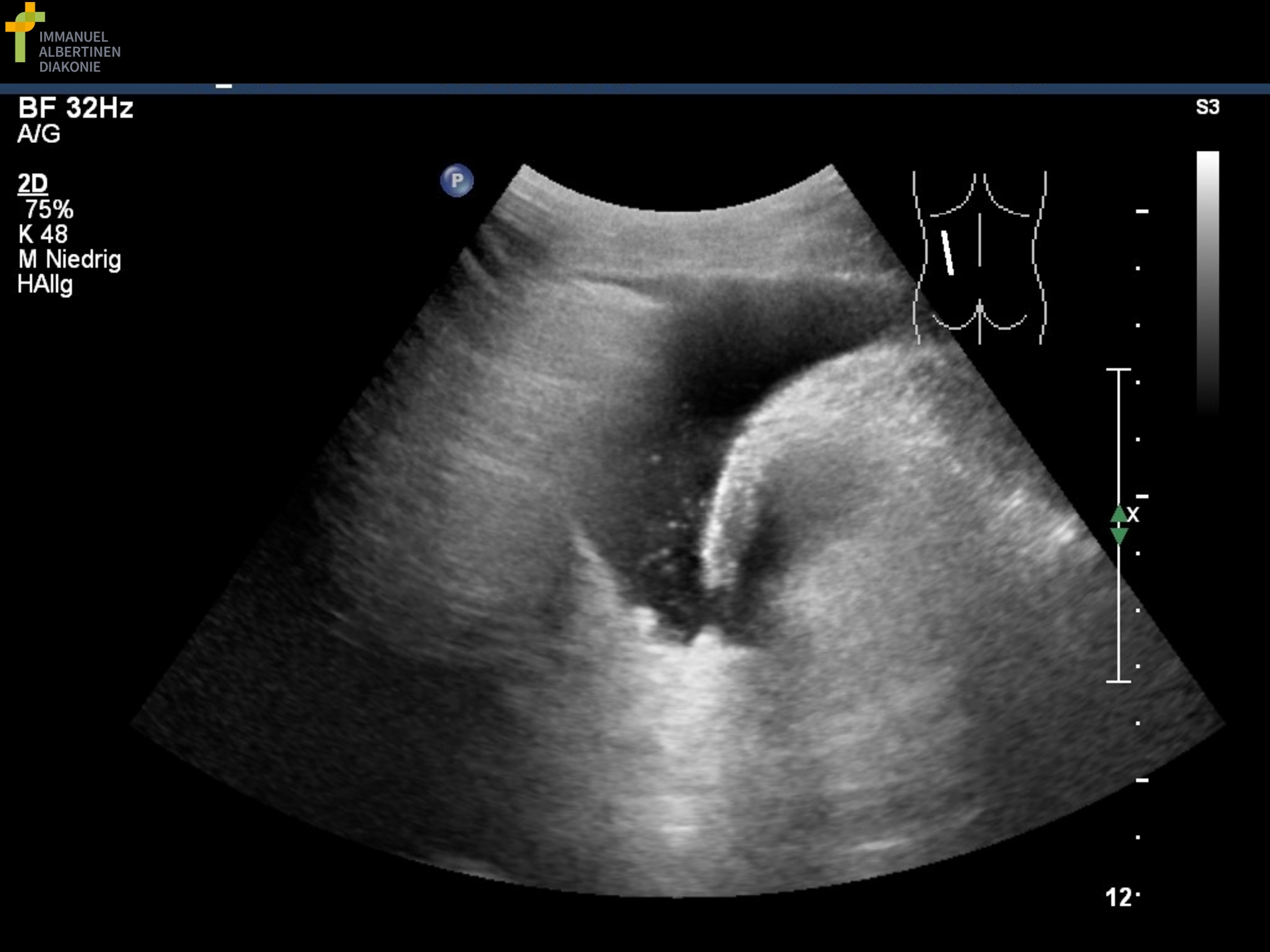 csm_Pneumothorax_01_330d597605.jpg