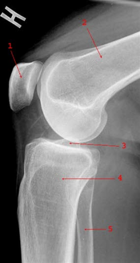 Normale Seitenansicht des Knies: 1 = Patella 2 = Femur 3 = Gelenkspalt 4 = Tibia 5 = Fibula