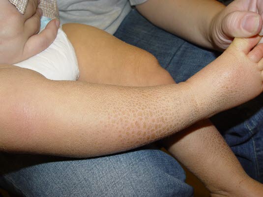 Ichthyosis vulgaris: Trockene und juckende Haut. 