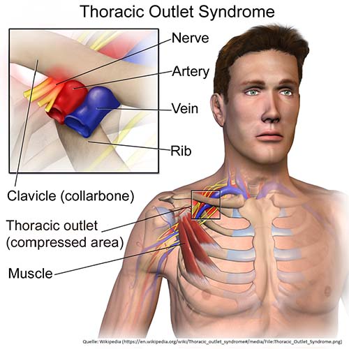 Thoracic_Outlet_Syndrome.jpg