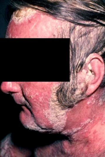 Erythrodermische Psoriasis