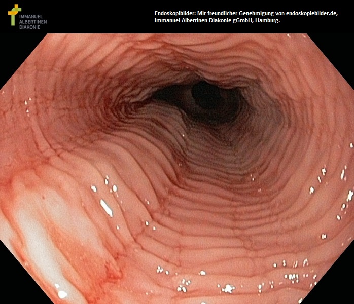 Eosinophile Ösophagitis.jpg