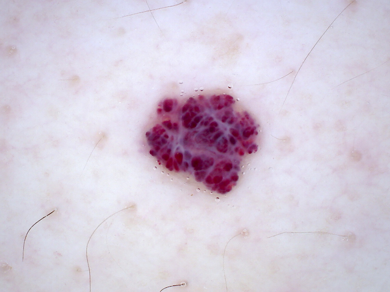 Cherry angioma dermoscopy.jpg