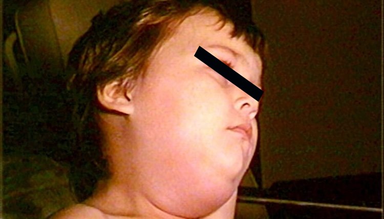 Mumps Mumps-1.0.jpg