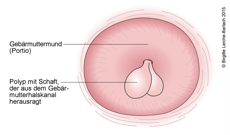 Zervixpolypen