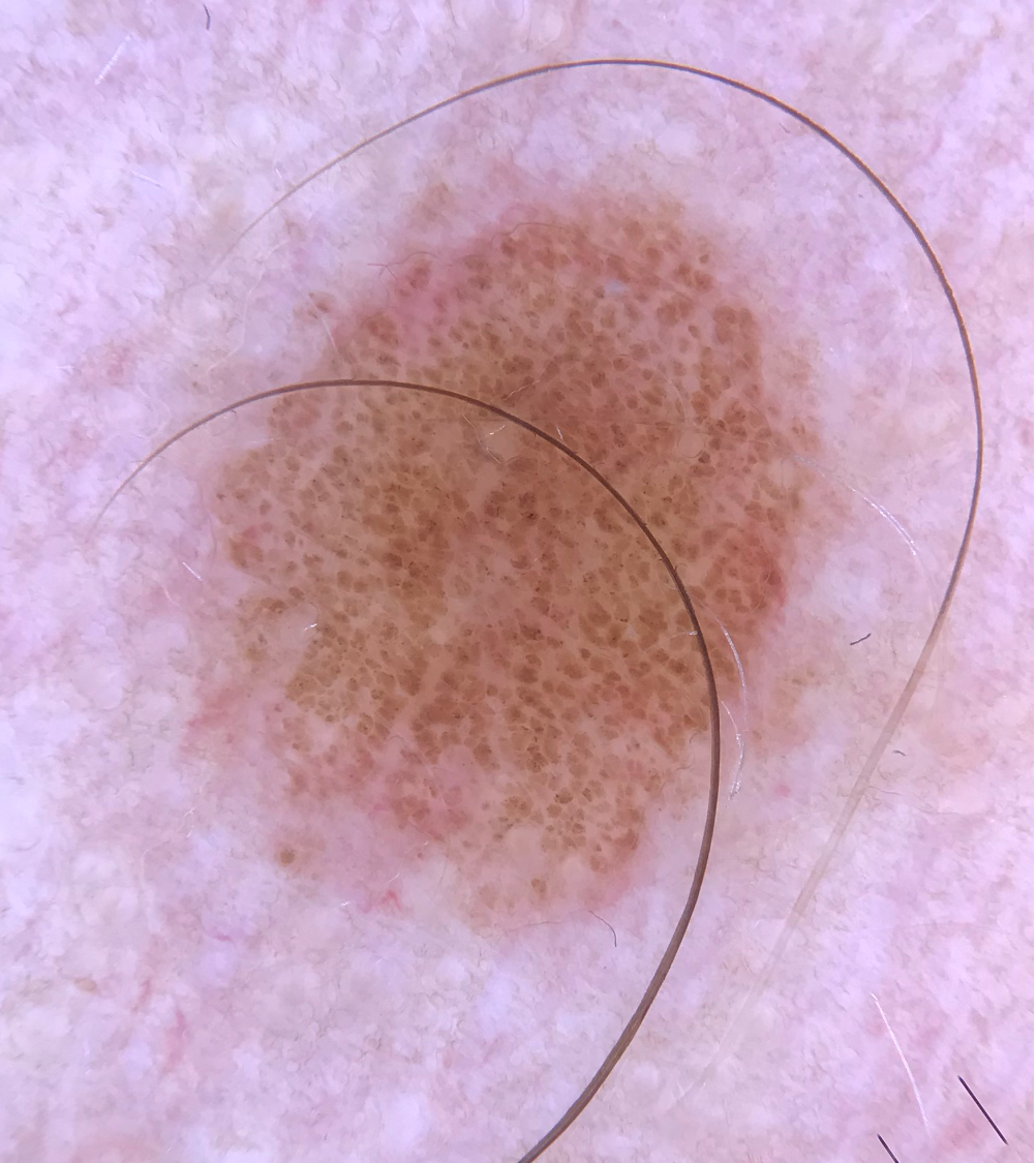 Globuli - Typiska - Intradermalt Nevus.png