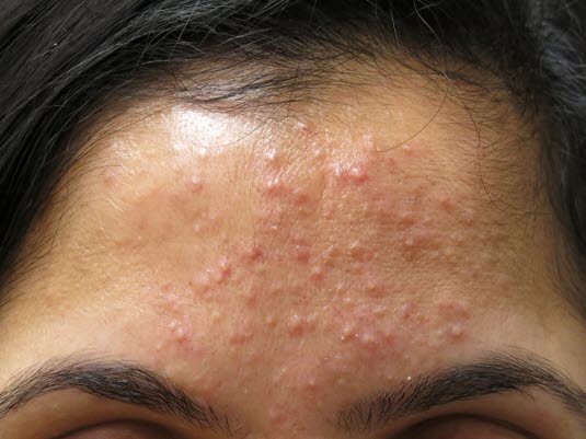 Acne papulopustulosa – gering bis mäßig ausgeprägt.