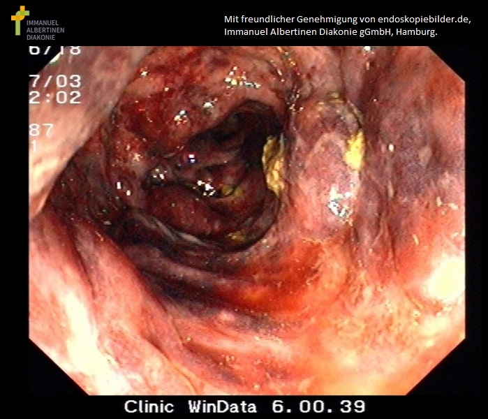 Hämorrhagische ischämische Colitis.jpg