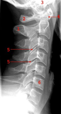 Normales Seitenbild der Halswirbelsäule: 1 = Prosessus spinosus 2 = Atlas 3 = Schädelbasis 4 = Dens axis 5 = Intervertebralgelenk (Facettengelenk) 6 = Wirbelkörper C6