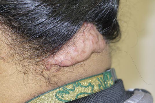 Folliculitis keloidalis ist bei Männern 20-mal häufiger und kann mehrere Jahre andauern. Vermutlich handelt es sich eine Infektion infolge eingewachsener Haare oder um eine eigene Erkrankung/Hautleiden, die unabhängig von diesen Faktoren auftritt.