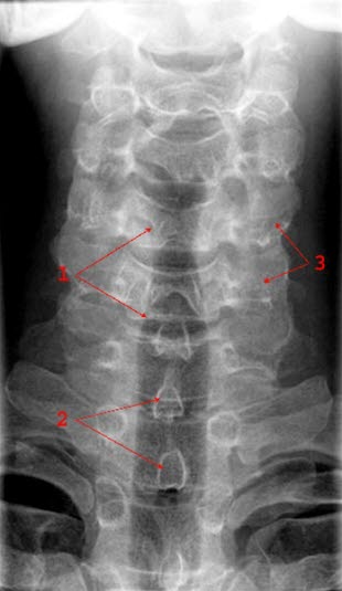 Normales Frontalbild der Halswirbelsäule: 1 = Trachea 2 = Processi spinosi (Dornfortsätze) 3 = Prosessus transversi (Querfortsätze)