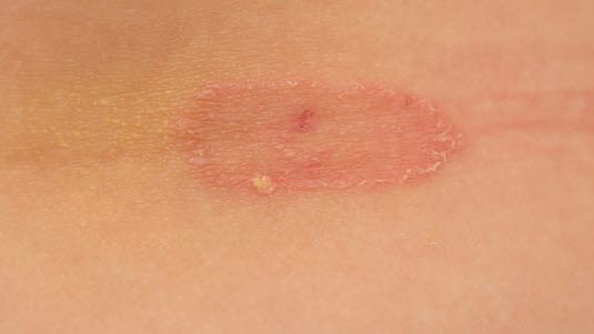 Ringelflechte Tinea Corporis Deximed