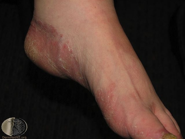 4222-2-tinea-pedis.jpg