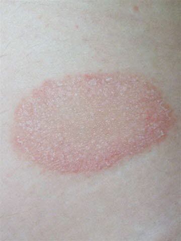 Primärmedaillon bei Pityriasis rosea. 