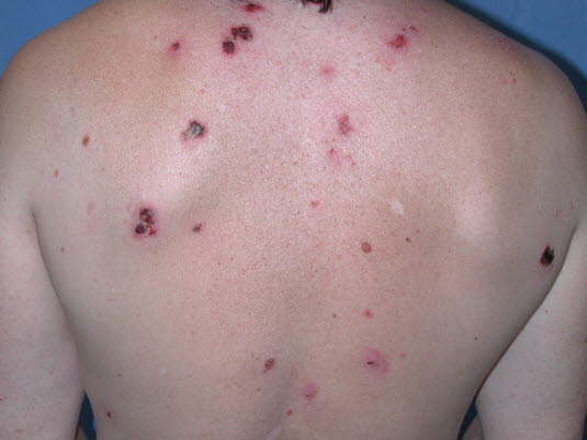 Pemphigus führt zu intraepidermalen Bullae auf der Haut und den Schleimhäuten. In einigen Fällen können Erosionen und Krusten über den Blasen dominieren.