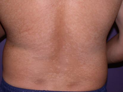 Kleienpilzflechte Pityriasis Versicolor Deximed