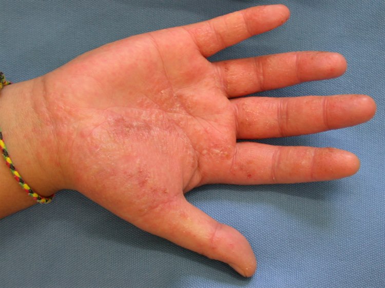Dyshidrosis Dyshidrosis