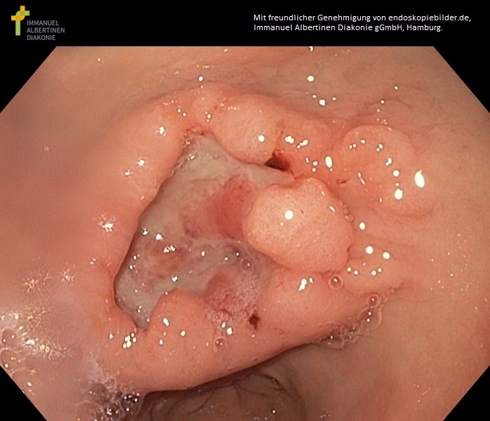 Ulzeröses Antrum-Karzinom.jpg