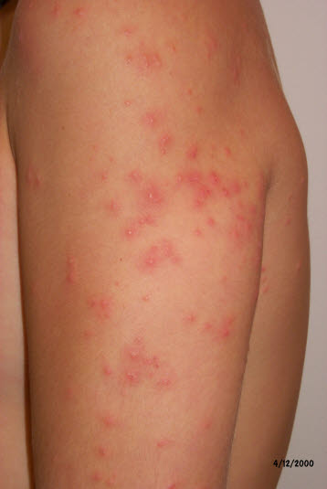 Zerkariendermatitis (Badedermatitis)