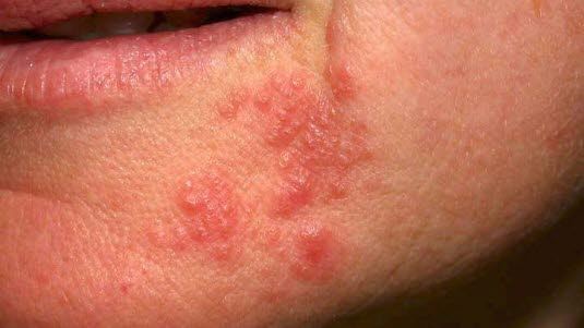 Ausschlag Um Den Mund Periorale Dermatitis Deximed