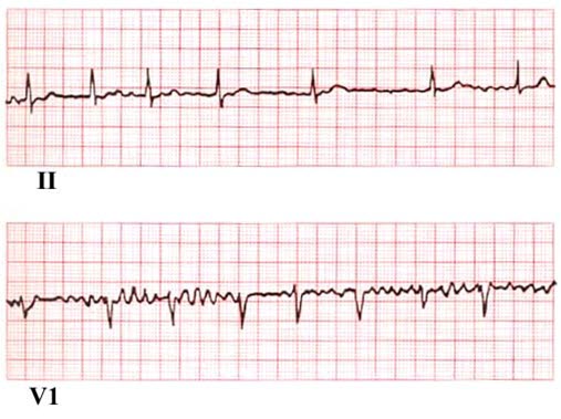 EKG bei Vorhofflimmern.jpg