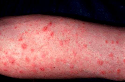 Pityriasis rosea. Zentrale Ausbreitung der Effloreszenzen über den  Körperstamm und die proximalen Extremitätenabschnitte.