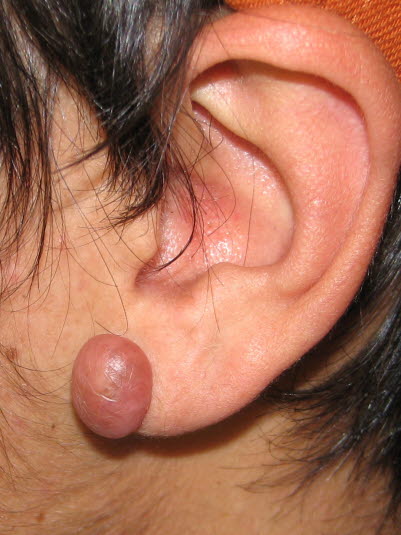 Keloid: Frühere Traumata, Akne, Ohrlöcher, Windpocken, Impfungen und Biopsieeingriffe sind die häufigsten prädisponierenden Faktoren.