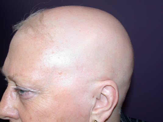 Alopecia totalis