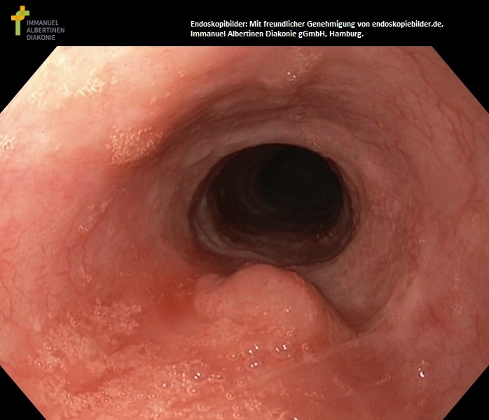 Plattenepithel-Ca des Ösophagus.jpg