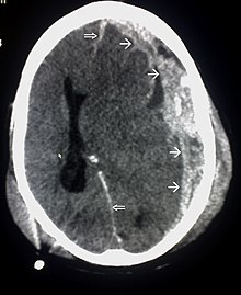 220px-Trauma_subdural_arrows.jpg