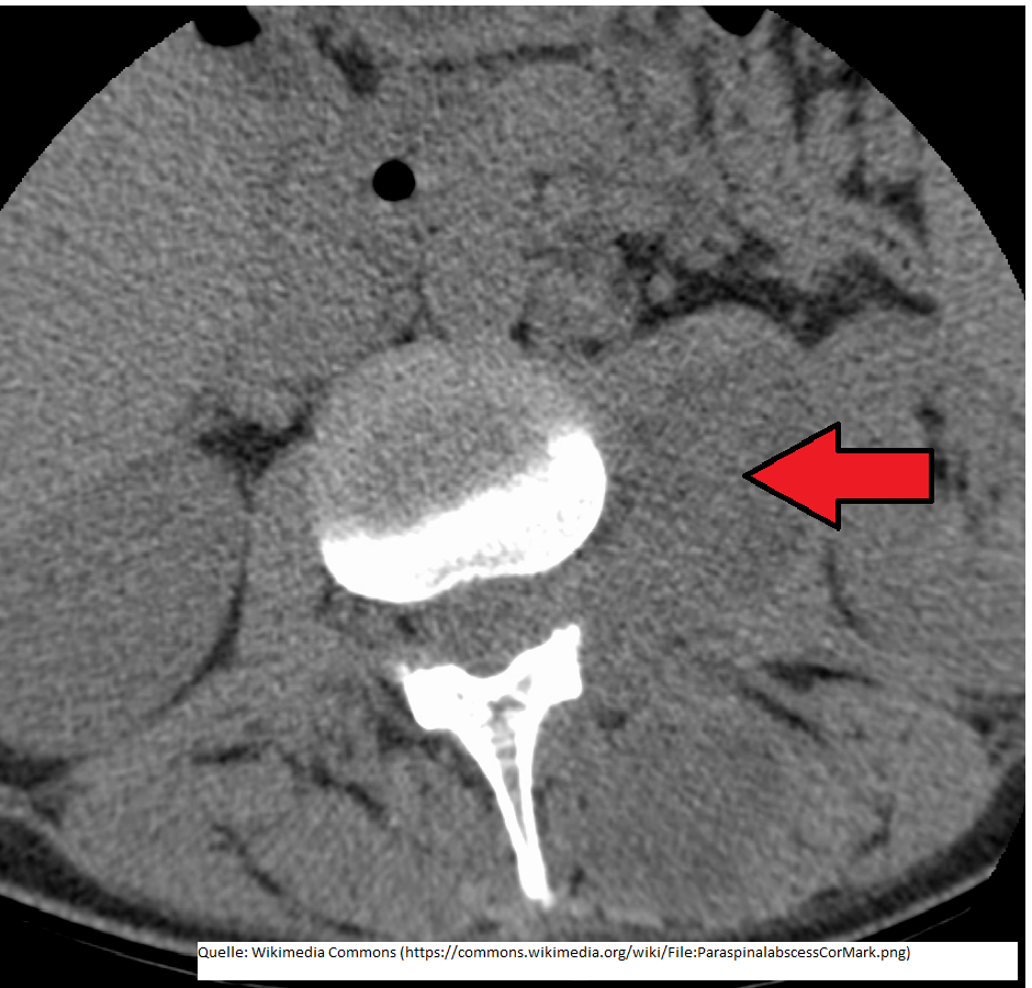 Paraspinaler Psoasabzess 2 (CT).png