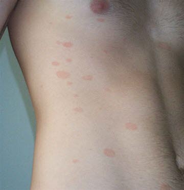 MildePityriasis rosea