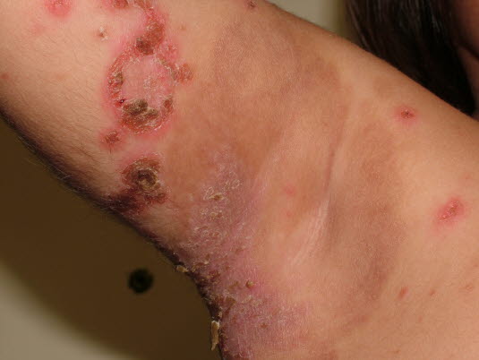 Eingetrocknete Impetigoblasen