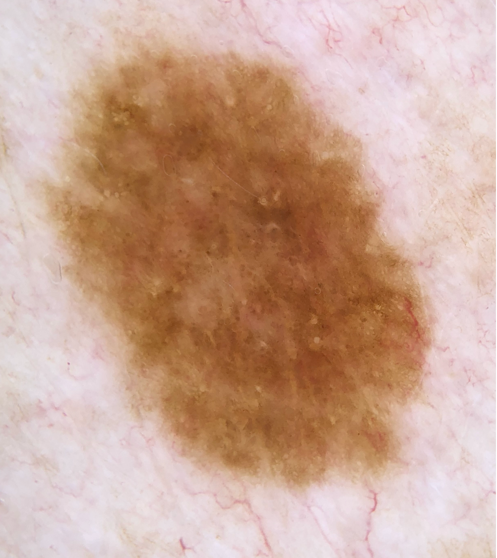 Dots - Typiska - Sammansatt Nevus.png