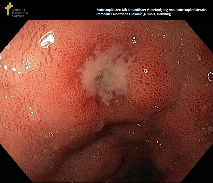 Ulus duodeni mit ödematöser Schleimhaut.jpg