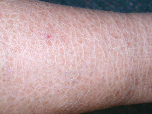 Ichthyosis. Symmetrische Schuppenbildung der Haut, die von kaum sichtbarer Rauheit und Trockenheit bis zu kräftigen, verhornten, großflächigen Schuppen reichen kann.