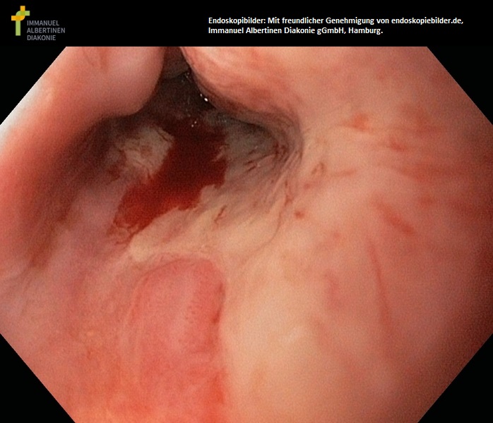 Refluxösophagitis III°.jpg