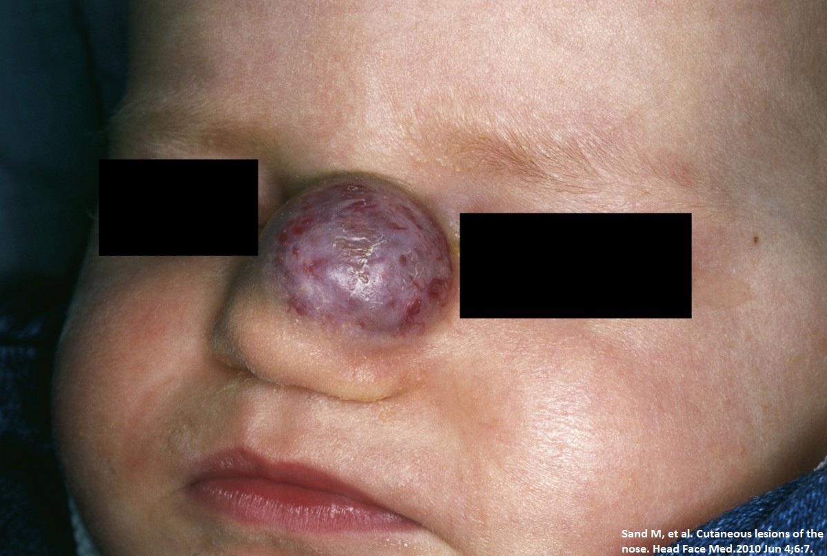 Hemangioma_01.jpg