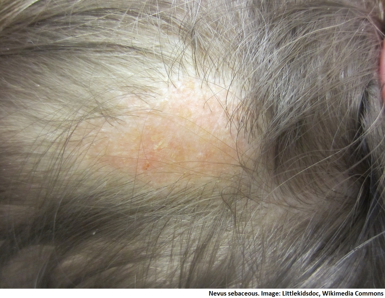 Nevus_sebaceous.jpg