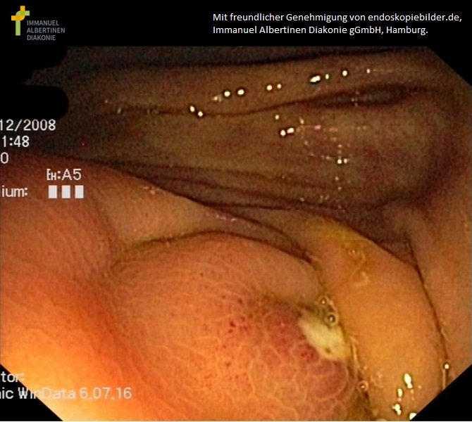 Appendizitis als Zufallsbefund.jpg