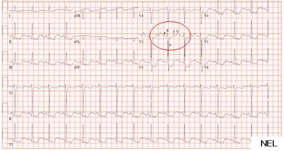 1509-2-hypokalemi-ekg.jpg