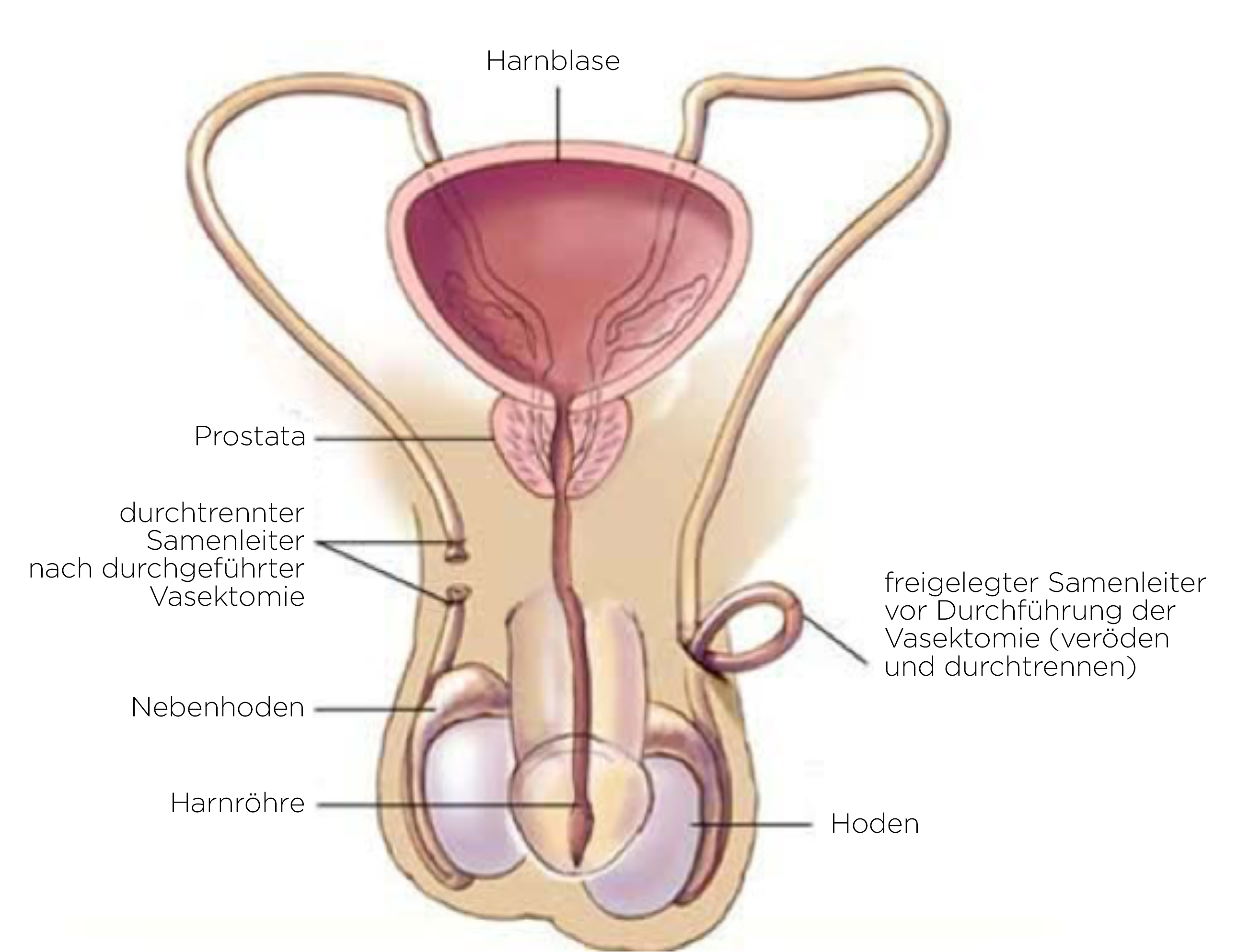 Sterilisation bei männern