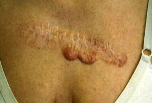 Keloid. Hypertrophe Narbenbildung, die über die ursprüngliche Begrenzung der Verletzung hinausgeht. 