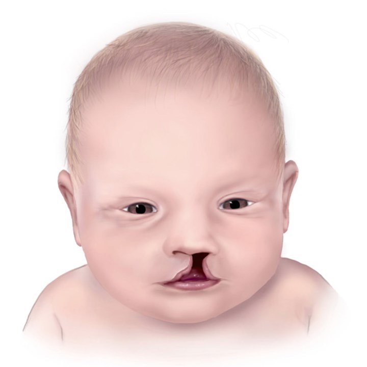 Linksseitige Lippen-Kieferspalte (Quelle: Centers for Disease Control and Prevention, National Center on Birth Defects and Developmental Disabilities)